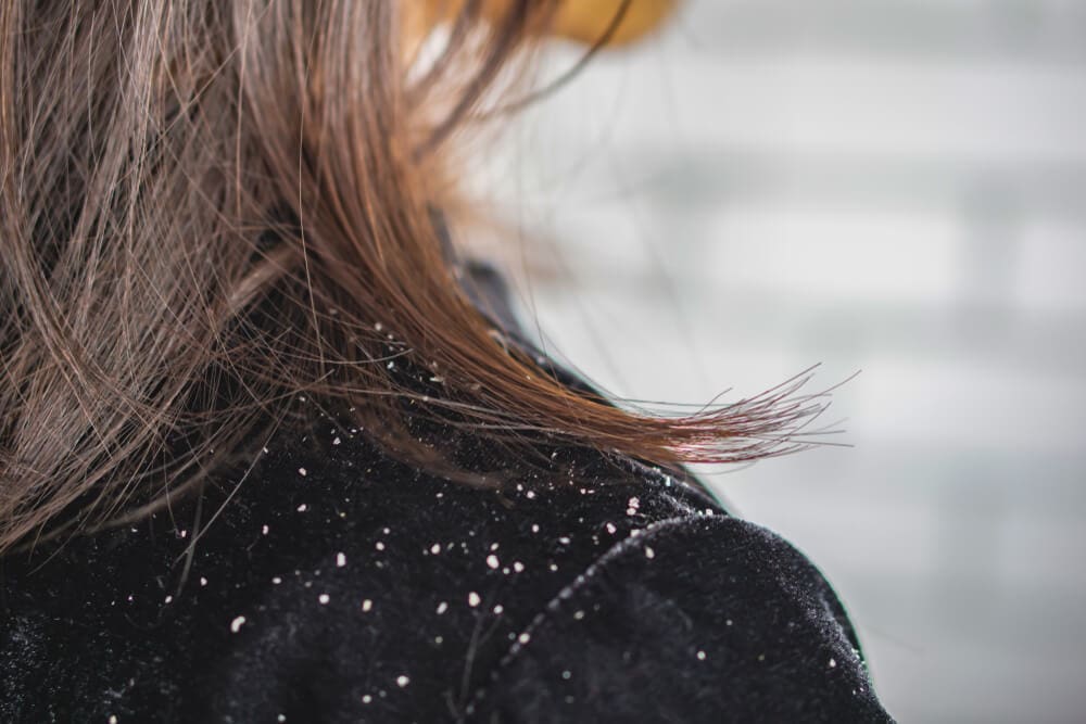 How To Get Rid of Dandruff, Techniques You Can Apply